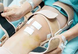 Stages Of Knee Replacement Surgery Recovery